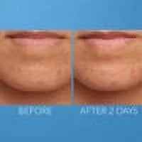 Acne Treatment 1 fl oz I466